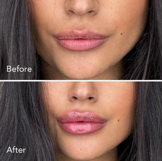 1ml Instant Lip Filler